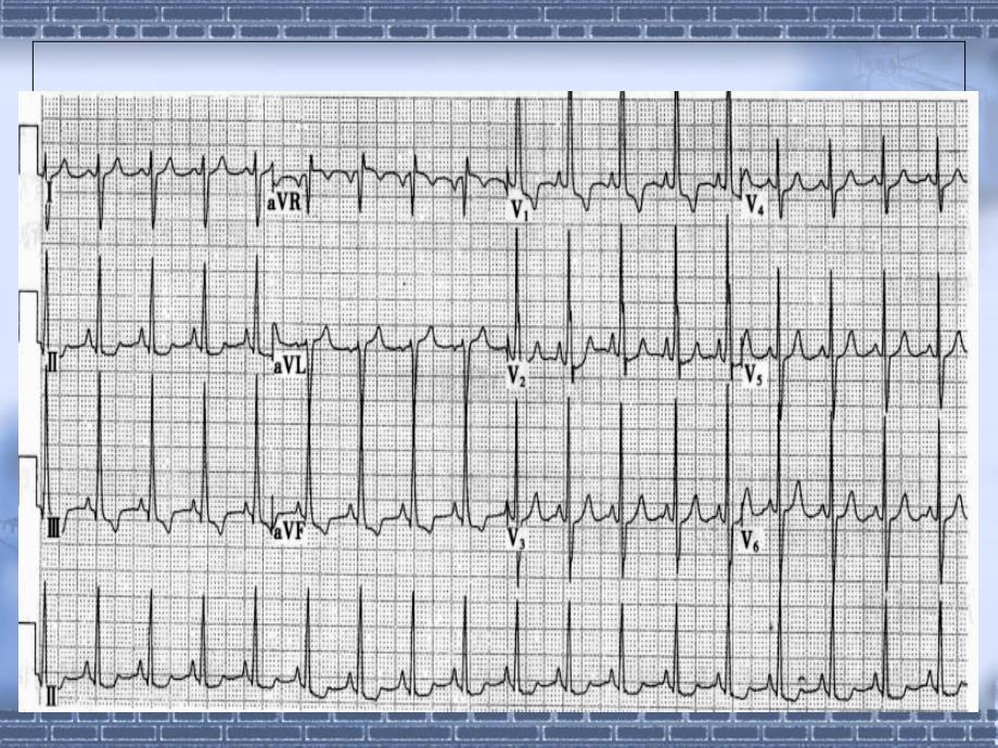 心电图的临床应用1_第4页