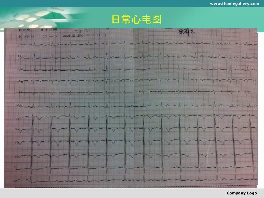 右冠闭塞前降支严重扭曲钙化介入治疗一例_第4页