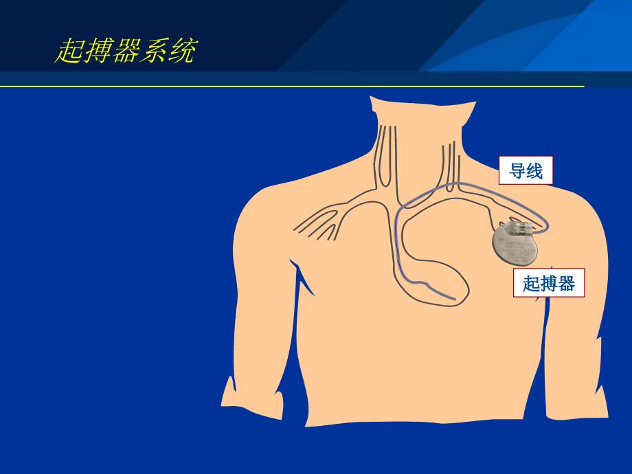 起搏器电极导线介绍PPT课件_第2页