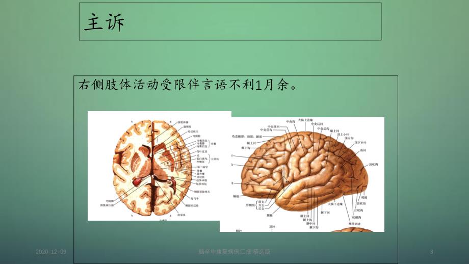 脑卒中康复病例汇报精选版_第3页