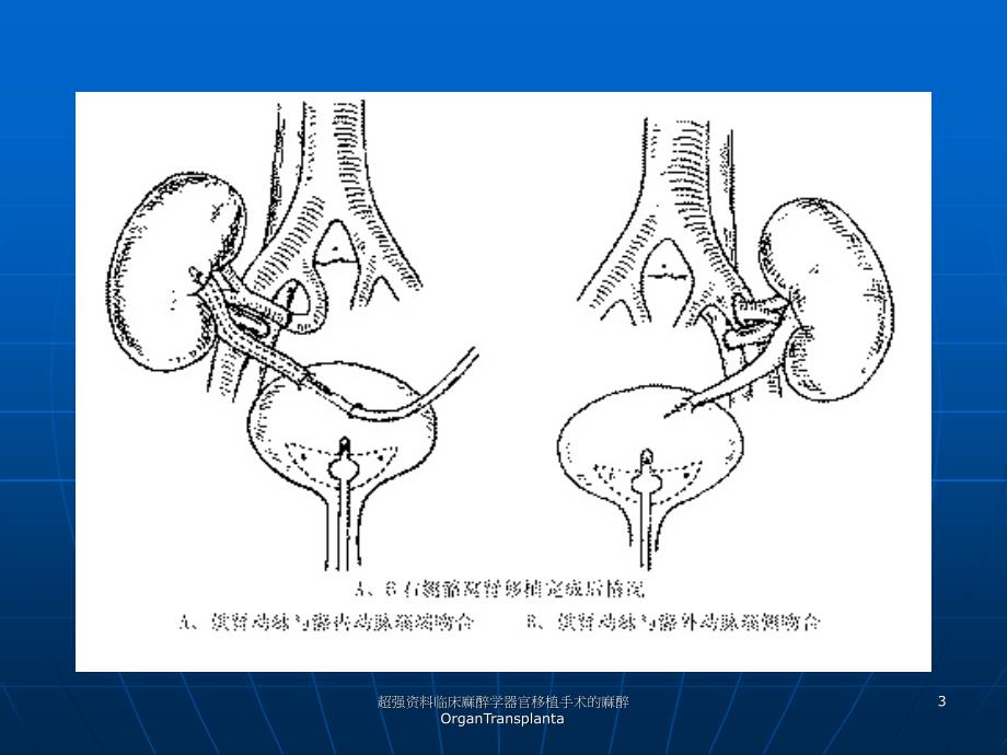 超强资料临床麻醉学器官移植手术的麻醉OrganTransplanta课件_第3页