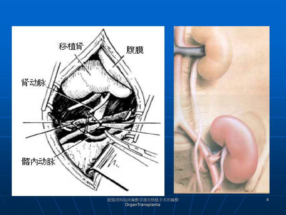 超强资料临床麻醉学器官移植手术的麻醉OrganTransplanta课件_第4页