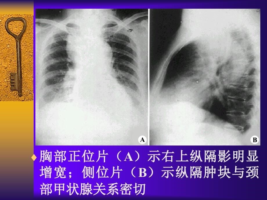 纵隔疾病影像表现_第5页