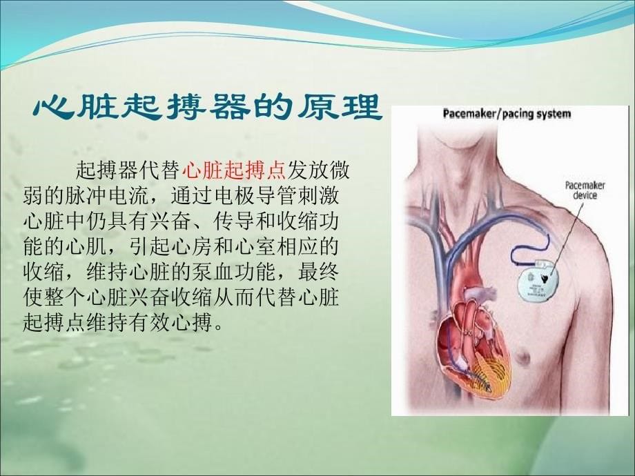 心脏起搏器植入术围术期护理演示课件_第5页