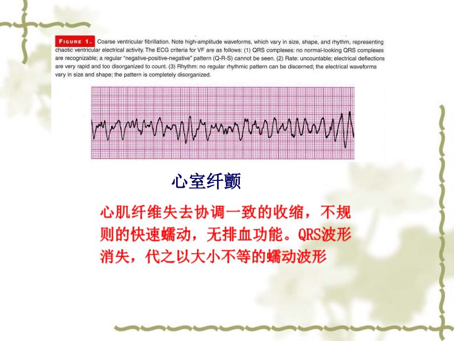 开胸心脏按压技术PPT课件_第4页