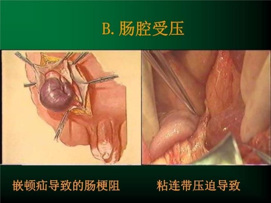 最新定义任何原因引起的肠内容物不能正常运行顺利通过肠道称肠梗阻PPT课件_第4页