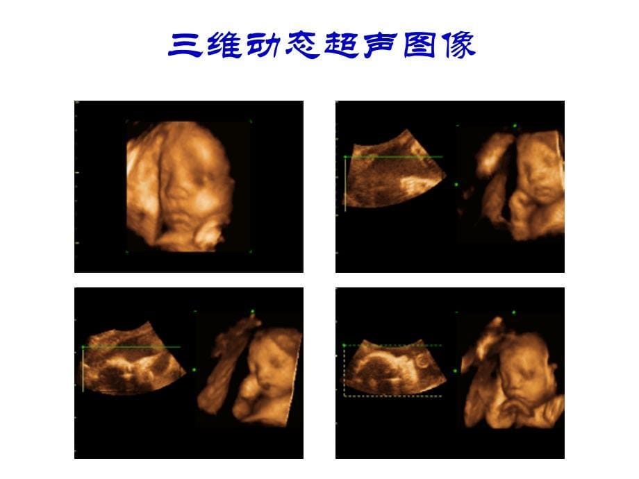 10超声波超声诊断仪的物理原理_第5页