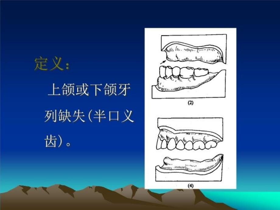 最新单颌全口义齿ppt课件_第3页