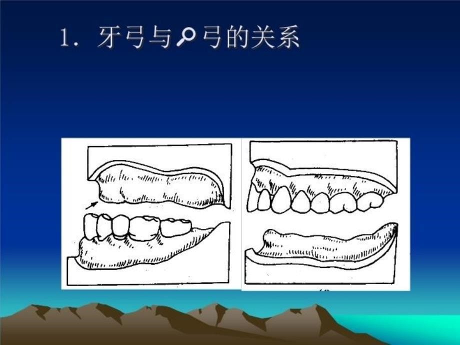 最新单颌全口义齿ppt课件_第5页