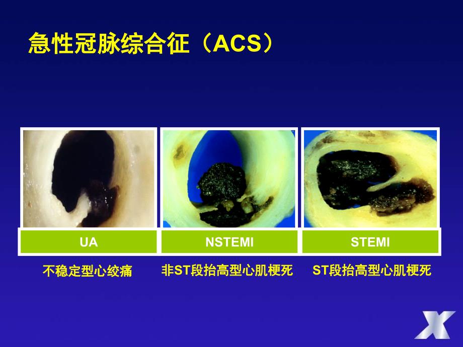 ACS抗凝治疗的风险与收益杨艳敏_第2页