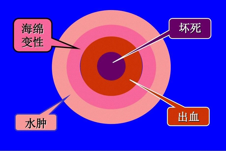 脑出血的分型分期治疗课件_第5页