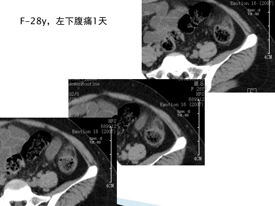 腹腔炎性脂肪性肿块的鉴别诊断_第1页