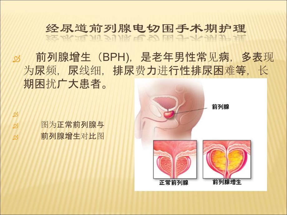 前列腺电切围手术期护理课件_第2页