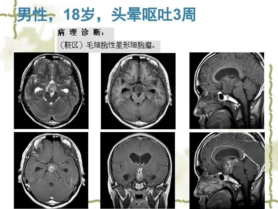 鞍区毛细胞型星形细胞瘤的MRI诊断及鉴别诊断_第5页