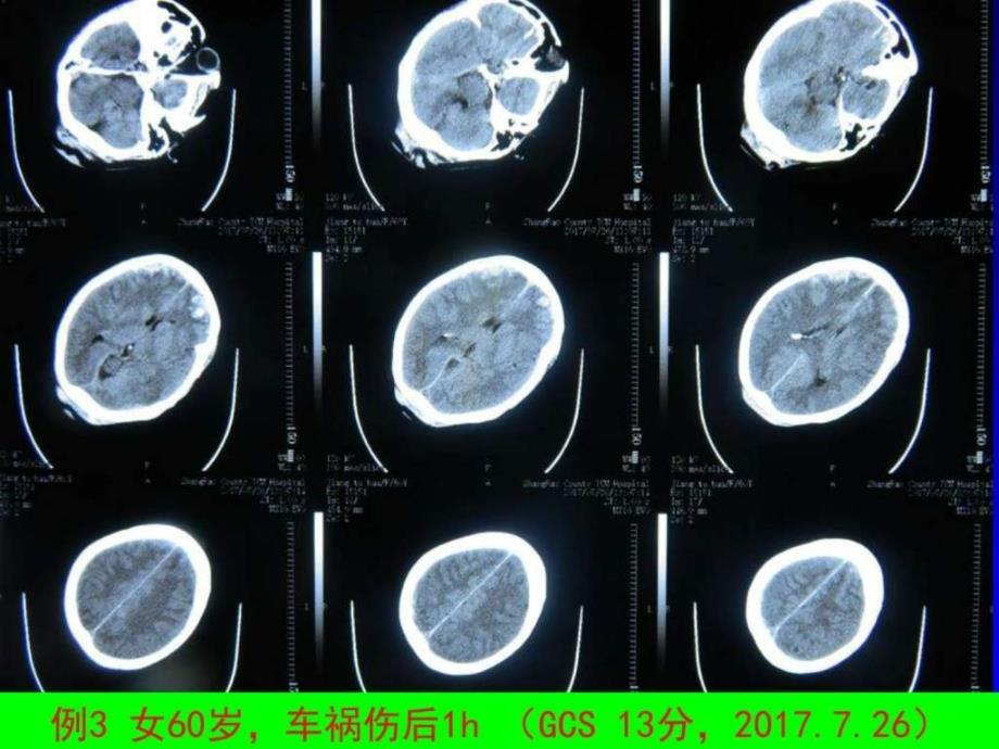 最新TBI的手术治疗长沙PPT文档_第3页