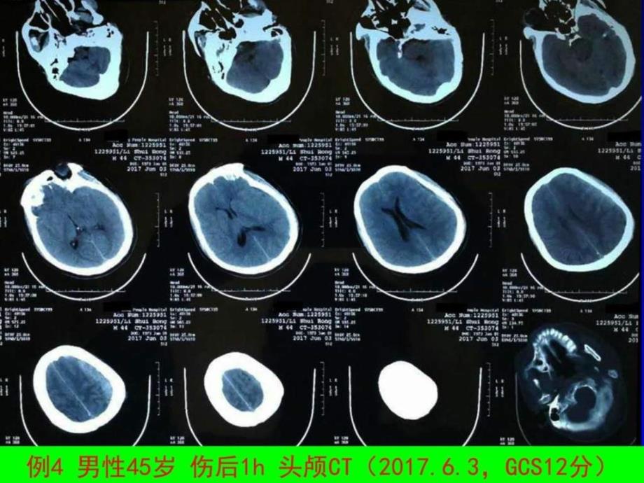 最新TBI的手术治疗长沙PPT文档_第4页