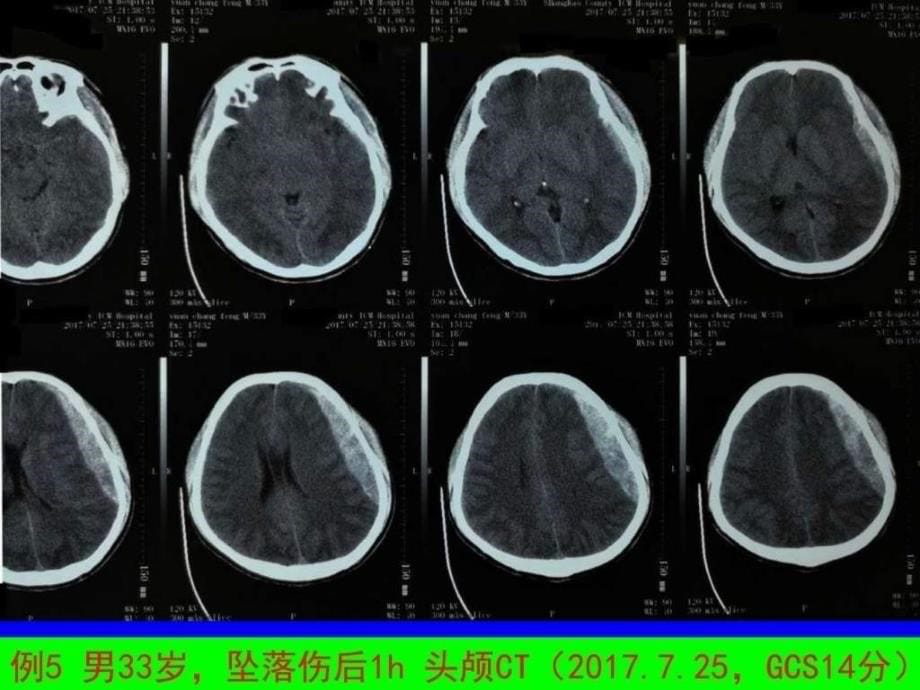 最新TBI的手术治疗长沙PPT文档_第5页