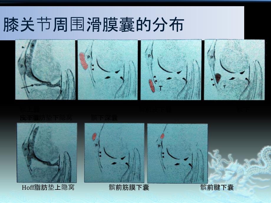 膝关节周围滑膜囊的解剖及MRI表现_第4页