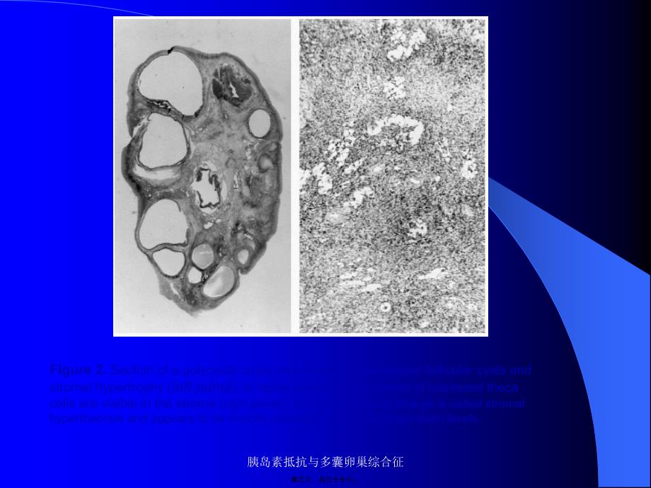 胰岛素抵抗与多囊卵巢综合征课件_第3页