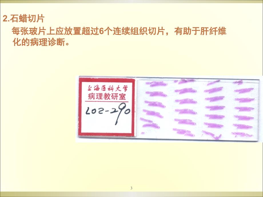 肝病的病理形态特点及免疫组化染色体会ppt课件_第3页