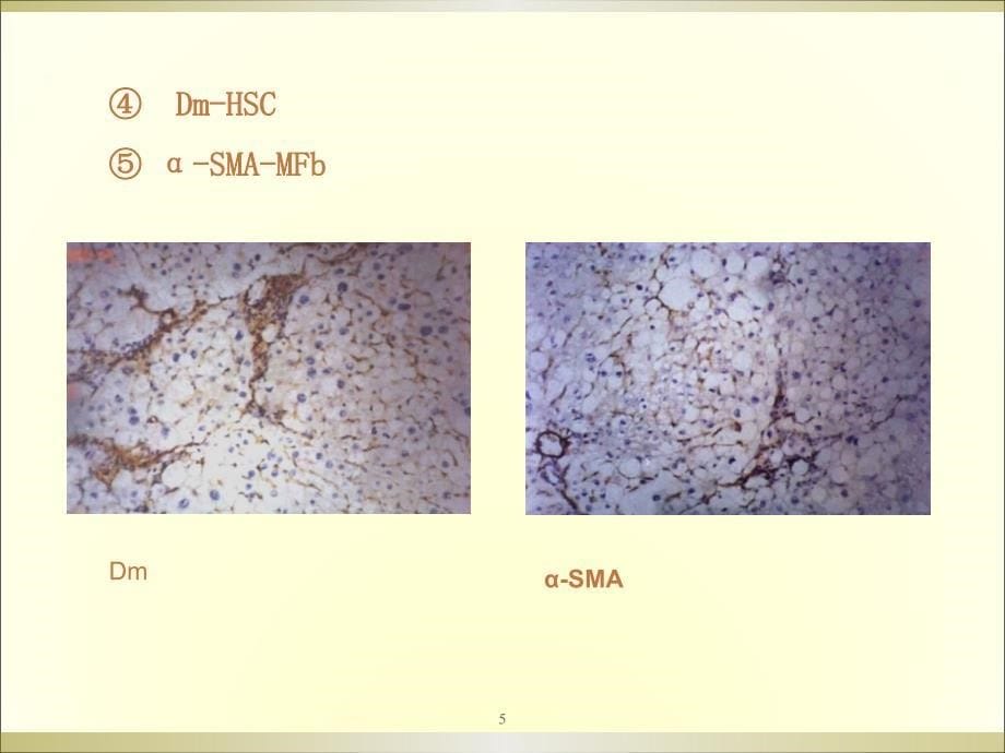 肝病的病理形态特点及免疫组化染色体会ppt课件_第5页