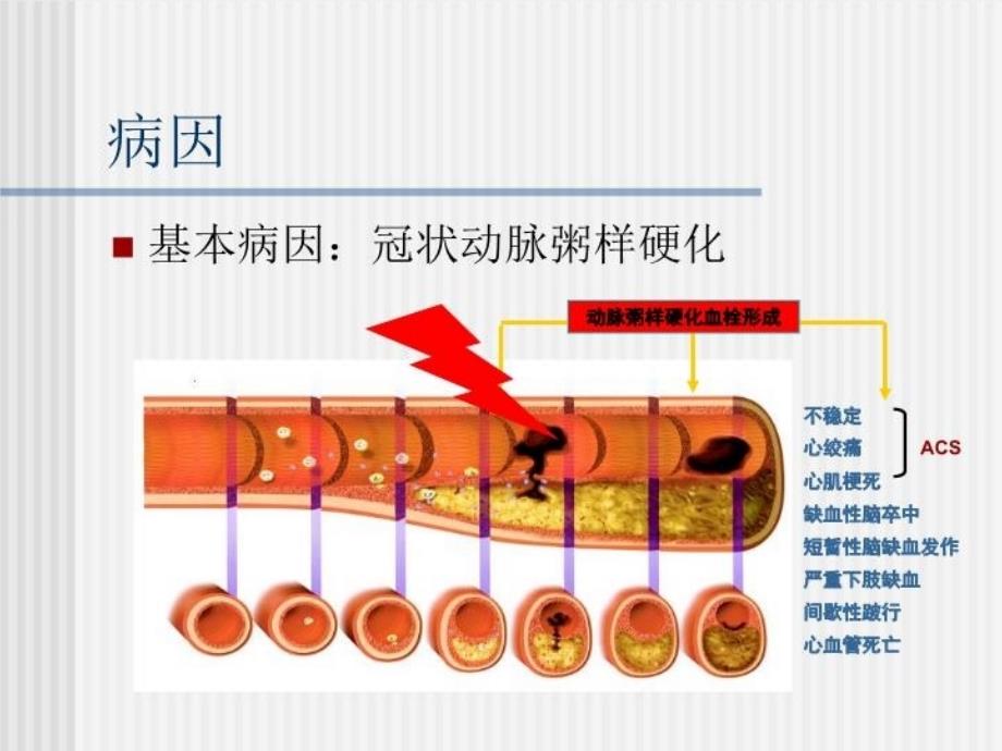 最新心梗疾病知识及护理PPT课件_第3页