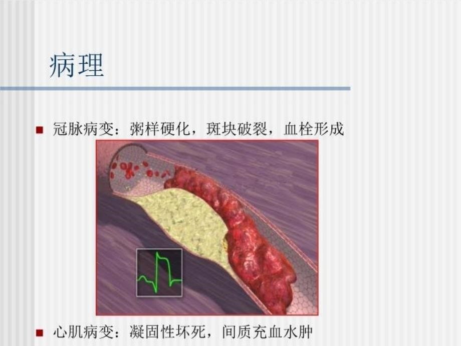 最新心梗疾病知识及护理PPT课件_第5页