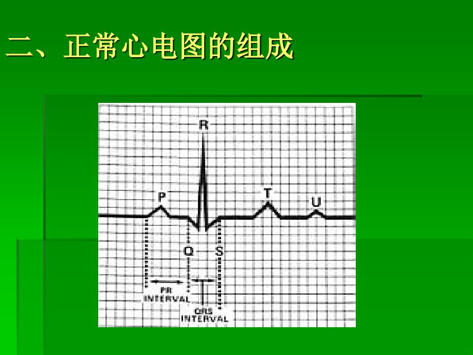 icu常见心电图知识_第3页