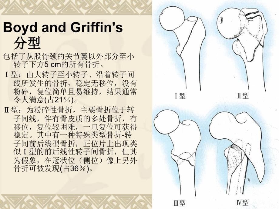 《转子间骨折》PPT课件_第5页