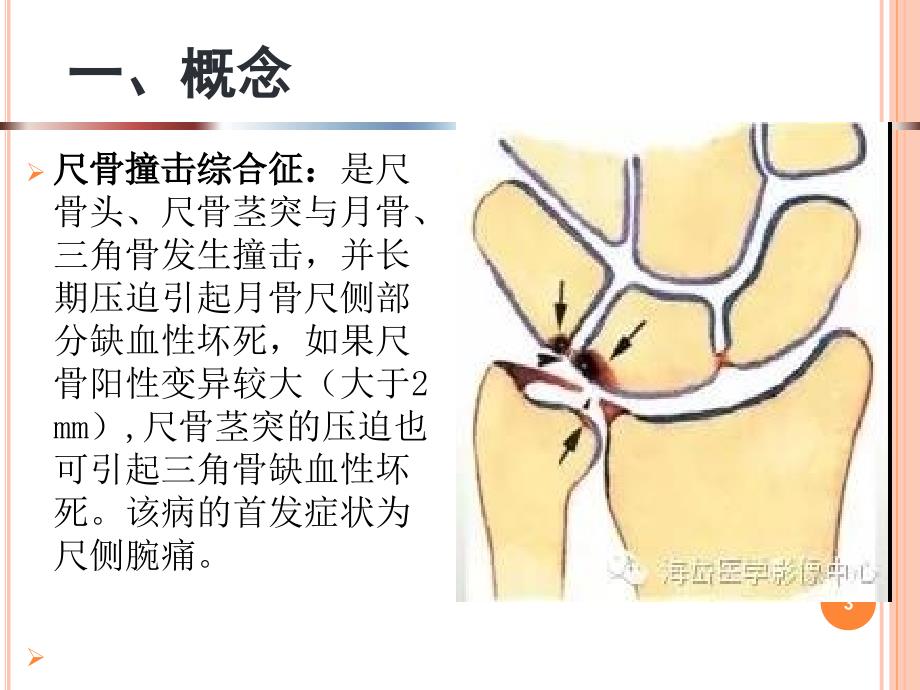 尺骨撞击综合征ppt参考课件_第3页