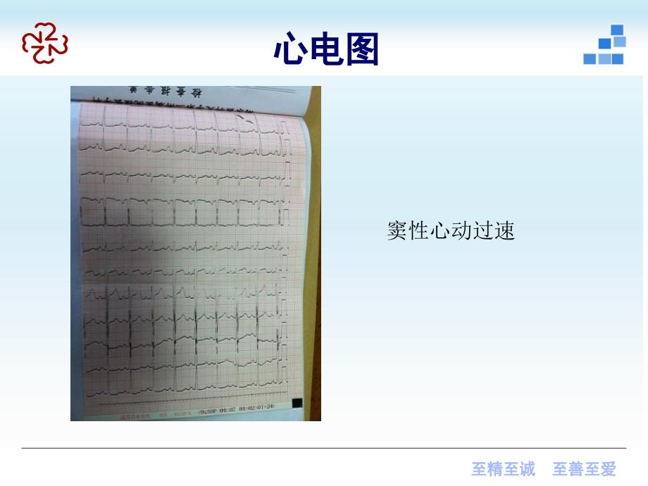 电击伤后心功能不全一例_第4页