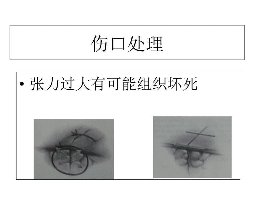 最新开放伤口处理PPT文档_第5页