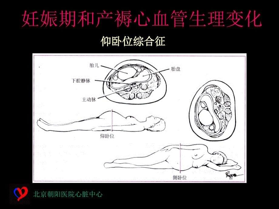 妊娠与心脏病1_第5页