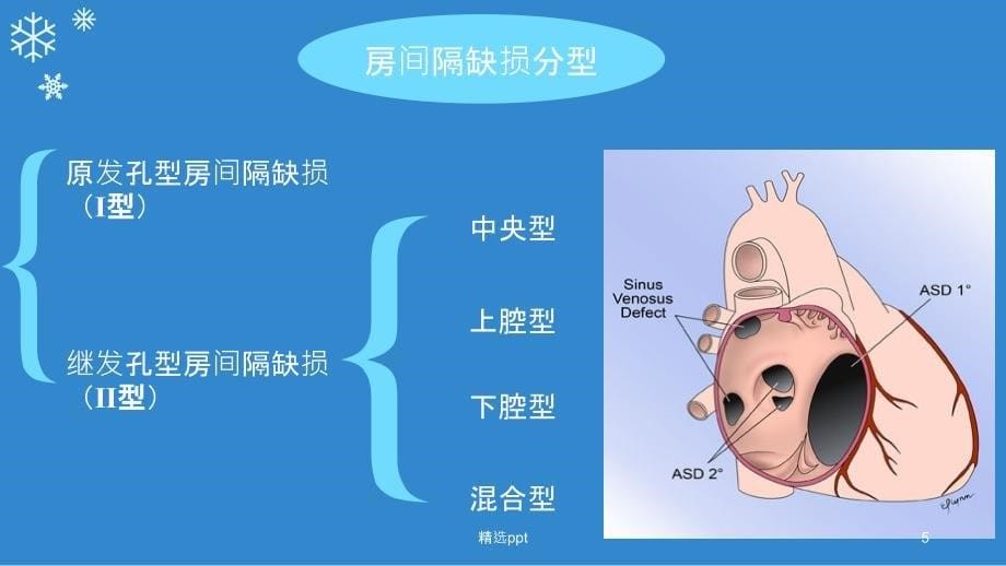 房间隔缺损PPT课件_第5页