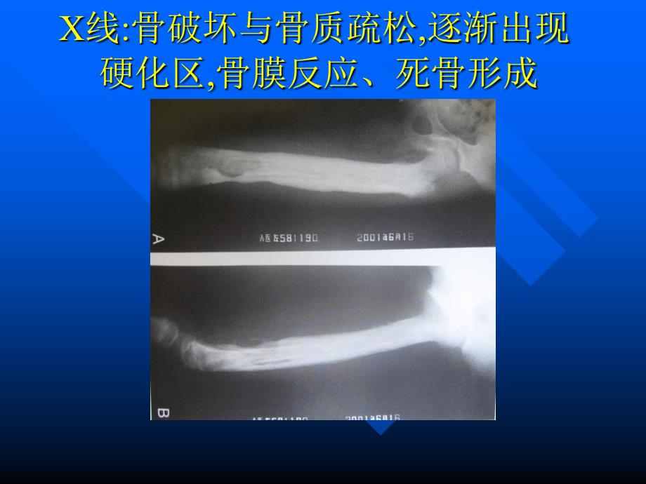 哈尔滨医科大学肿瘤外科学慢性血源性髓炎PPT文档资料_第4页