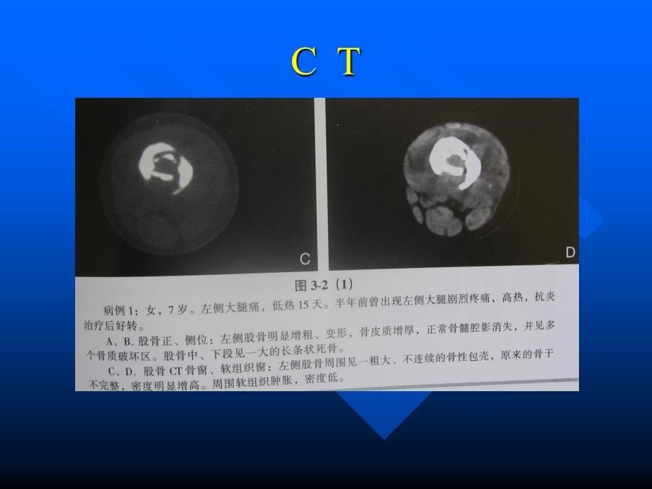 哈尔滨医科大学肿瘤外科学慢性血源性髓炎PPT文档资料_第5页