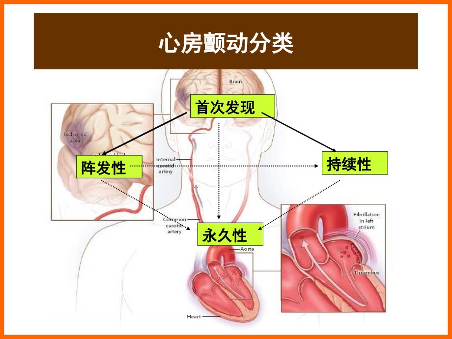 从ACCAHAESC指南看心房颤动治疗规范化与进展_第2页