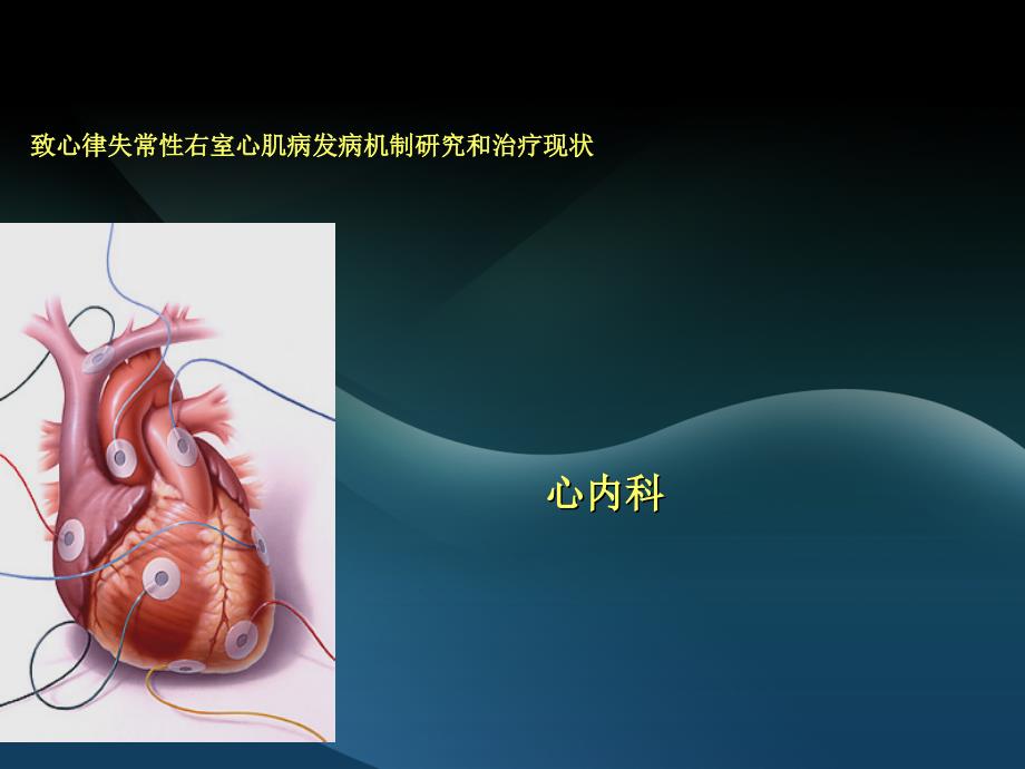 致心律失常性右室心肌病_第1页