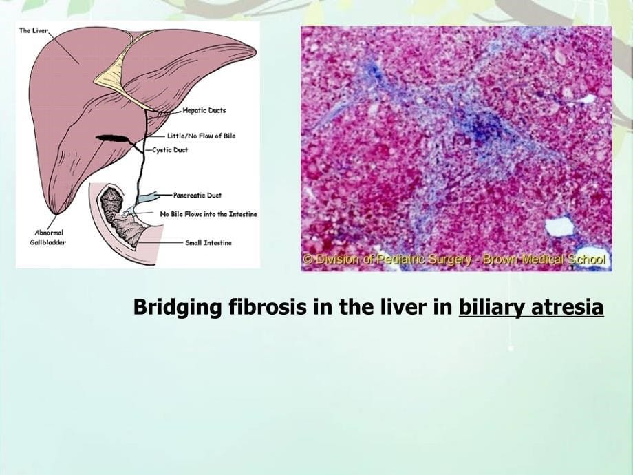 胆道疾病--课件_第5页