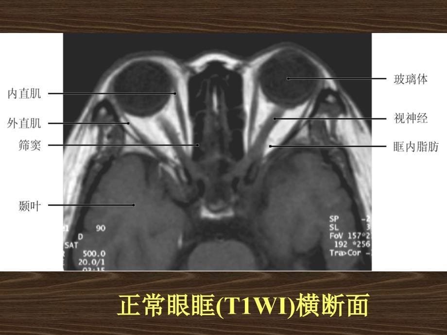 五官疾病MRI诊断_第5页