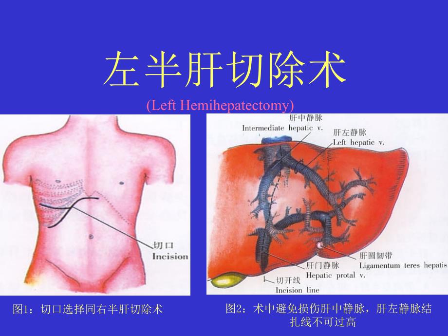 医学专题：左半肝切除术1汇总_第1页