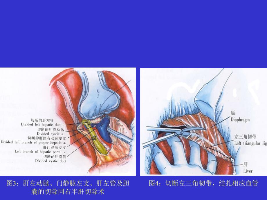 医学专题：左半肝切除术1汇总_第2页