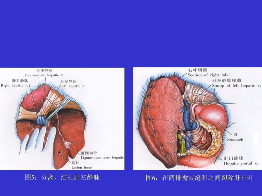 医学专题：左半肝切除术1汇总_第3页