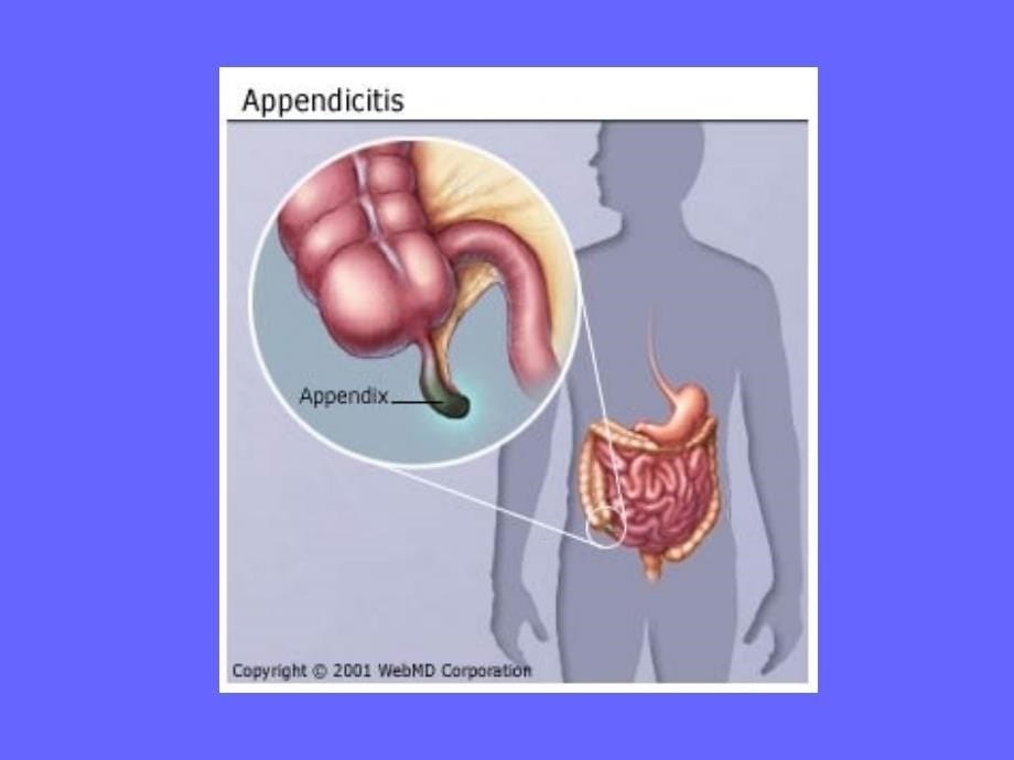 医学课件第二十二章阑尾炎病人的护理_第5页