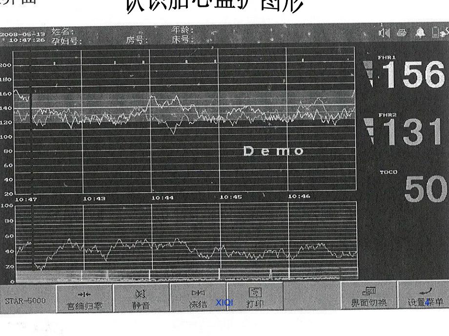 胎心监护分析_第4页