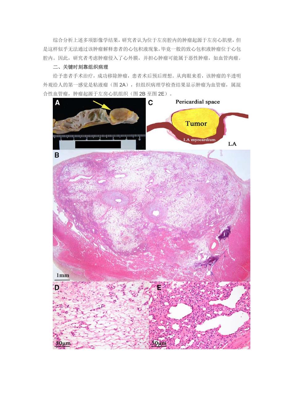 病例学习：房“内”肿瘤如何导致心包积液.doc_第2页