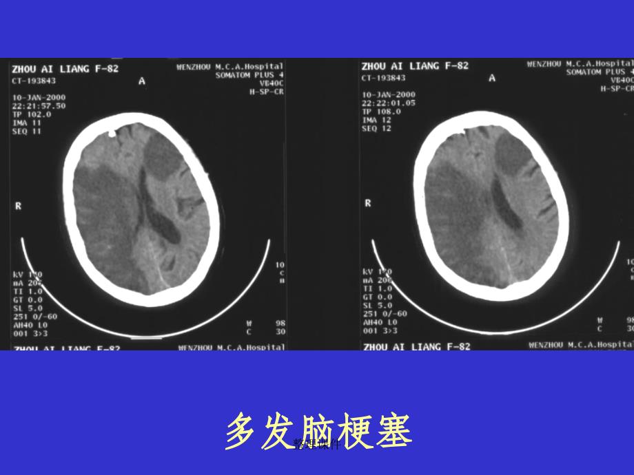 常见疾病的典型CT_第2页