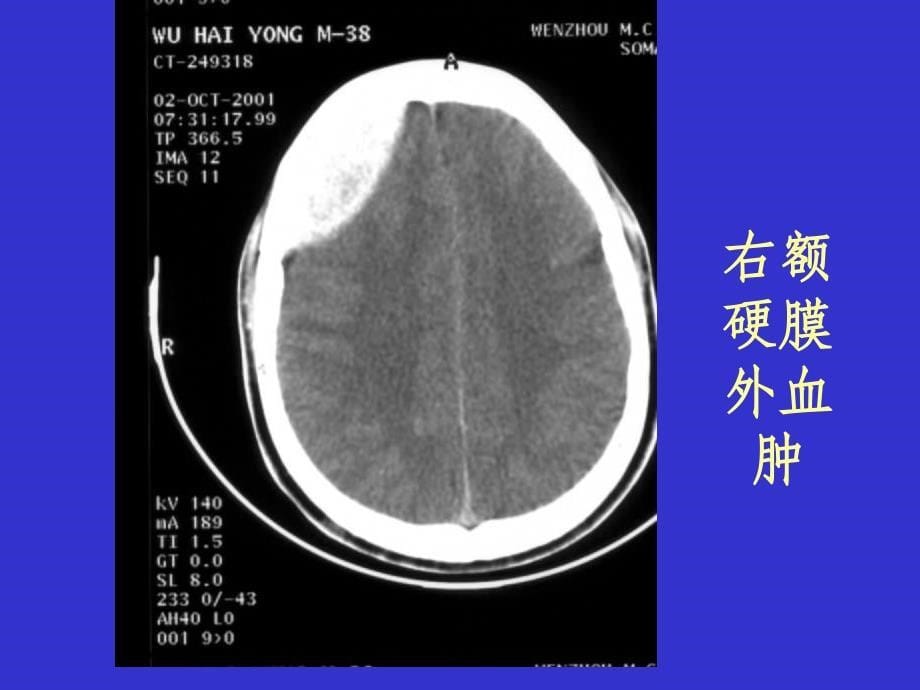 常见疾病的典型CT_第5页