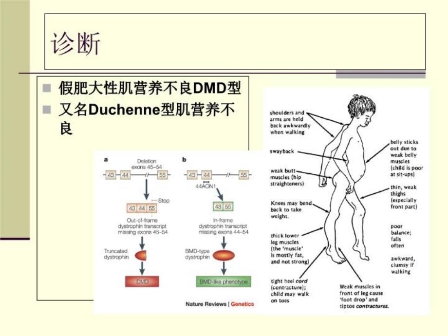 最新北京华科医院痿证科假肥大性肌营养不良幻灯片_第3页