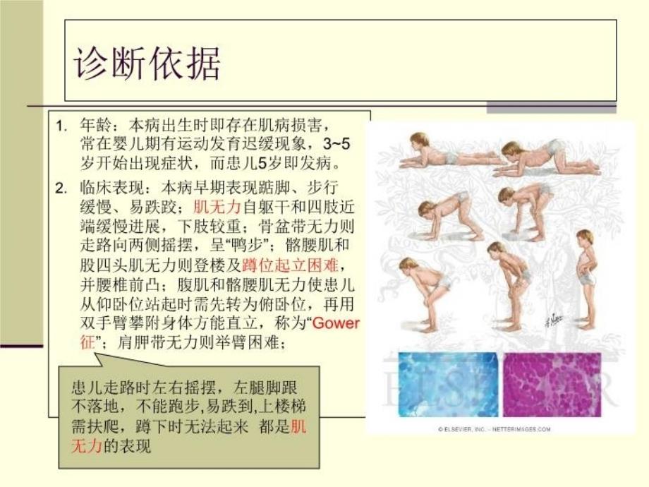 最新北京华科医院痿证科假肥大性肌营养不良幻灯片_第4页